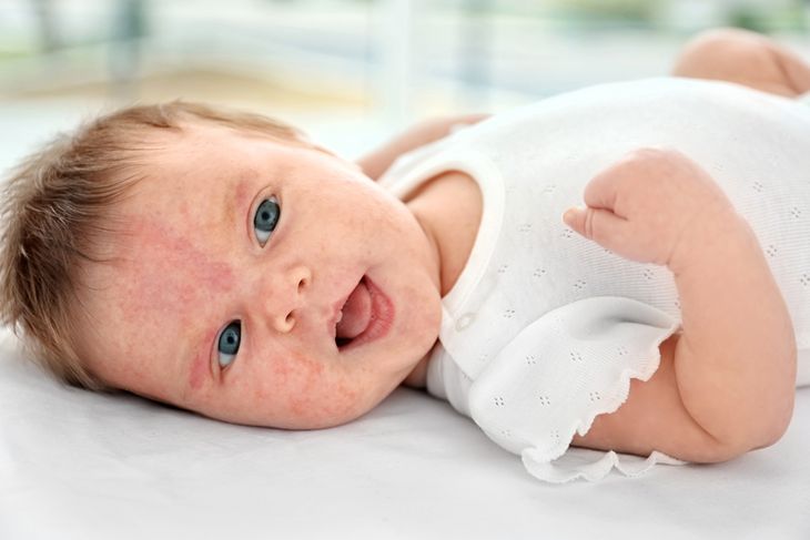 Alergia Pokarmowa U Niemowlaka Objawy I Leczenie Apteline Pl