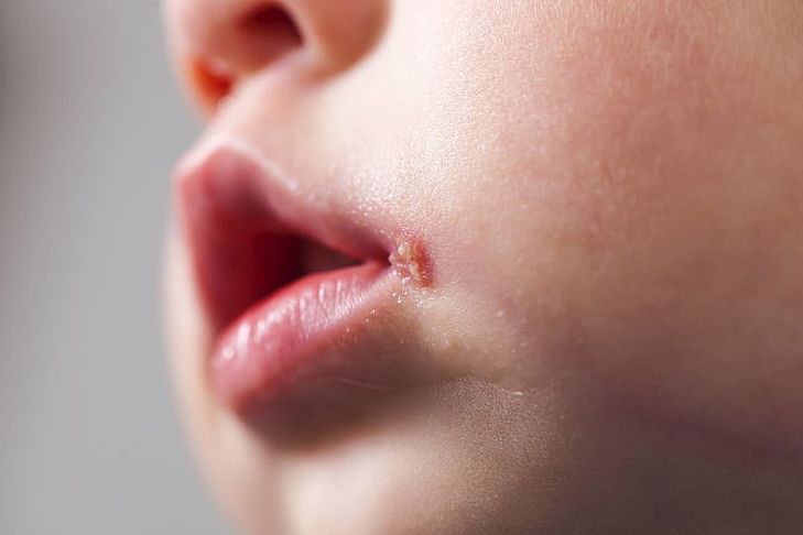 Opryszczka Na Ustach Przyczyny Fazy I Leczenie Ile Trwa Opryszczka Wargowa Apteline Pl
