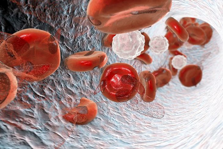 Anemia Objawy Leczenie Przyczyny Czym Jest Anemia I Jak Leczyć 2045